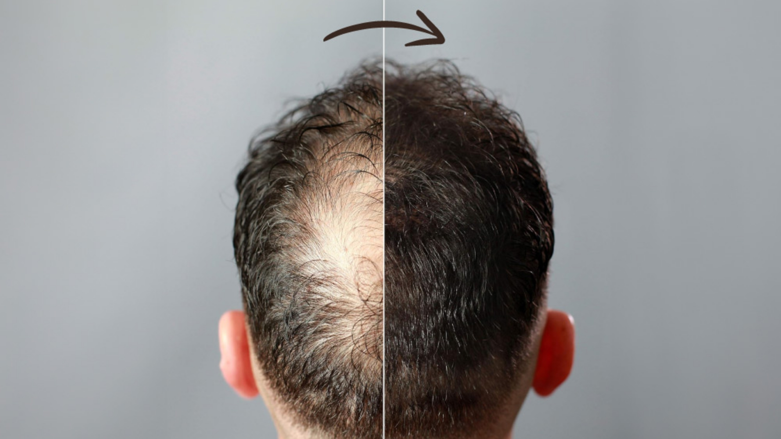 Hair Transplant UK – Transforming Confidence and Appearance Nationwide
