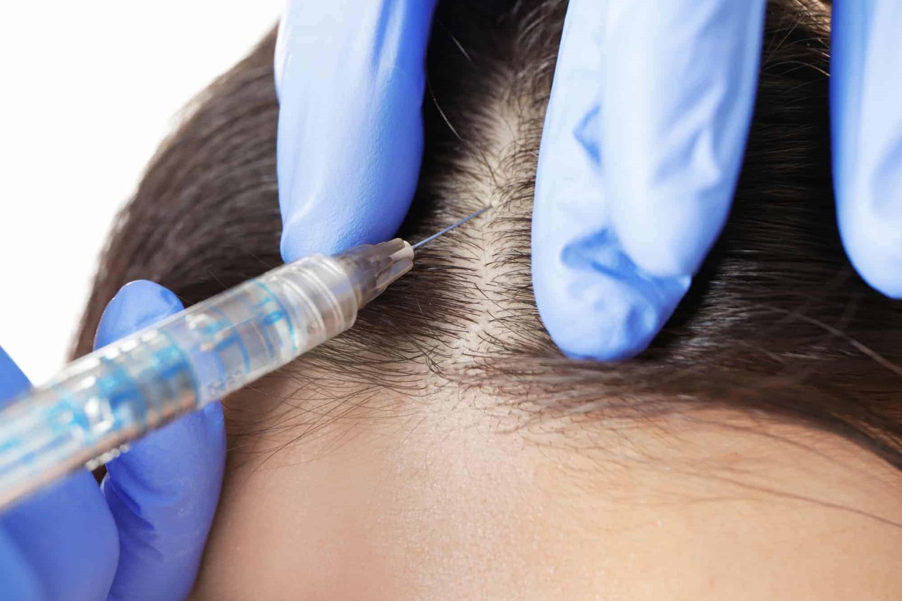 How to Prepare for a Hair Transplant Procedure